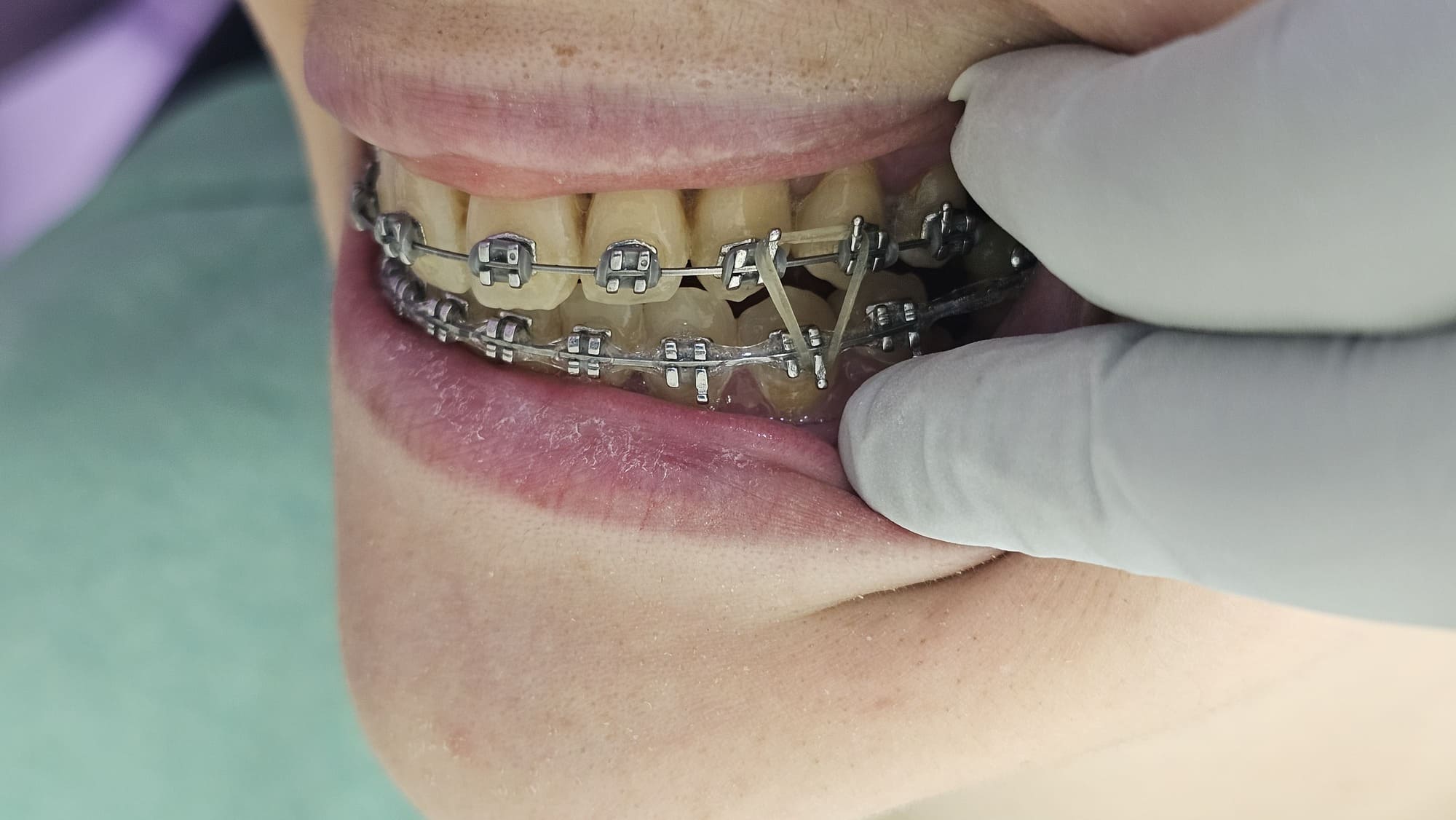 brackets metalicos